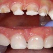 孕期能补牙洞吗（孕期能补牙洞吗牙很痛）