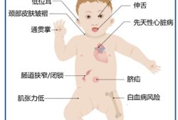 唐氏胎儿是什么意思（唐氏胎儿是怎么回事）
