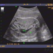 医生请问怀孕做彩超说孩子腹部肠胃管略扩张怎么回事,胎儿结肠扩张是什么原因导致的