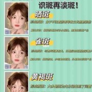 孕期祛斑小妙招（孕期祛斑小妙招有哪些）