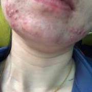 孕期下巴长痘是男孩吗（孕期下巴长痘是男孩吗）