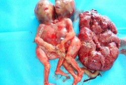 5个月引产胎儿图片（5个月引产胎儿图片是什么样子?）