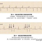 胎儿频发性早搏的危害（频发室性早搏严重吗？有危险吗）