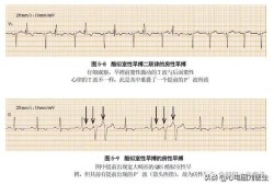 胎儿频发性早搏的危害（频发室性早搏严重吗？有危险吗）