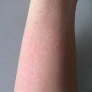 孕期皮肤过敏了怎么办（孕期皮肤过敏了怎么办）