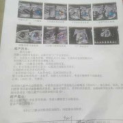 胎儿右心偏大（胎儿右心偏大一般会是什么问题）