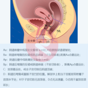 孕期阴道会松弛吗（阴壁膨出1度2度3度图）
