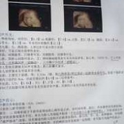 四维彩超心脏有强光点怎么办,24周胎儿左心室强光点怎么办