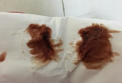 怀孕6周出现褐色血该怎么办,孕期出褐色血要紧吗
