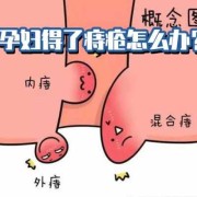 孕期  痔疮（孕期长痔疮怎么治疗）