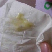 怀孕期间白带发黄图片