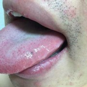 孕期舌头发黑（孕期舌头发黑是什么原因引起）