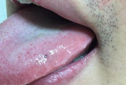 孕期舌头发黑（孕期舌头发黑是什么原因引起）