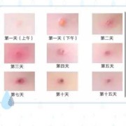 出水痘的危害有哪些,孕期水痘对胎儿的影响