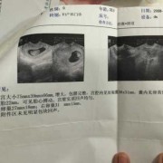 胎囊里面是胎儿吗（孕囊的读音）