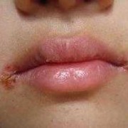 孕期烂嘴角（孕期烂嘴角是什么原因引起的）