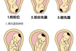 胎儿俯位（胎儿俯位）