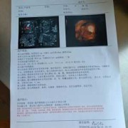 胎儿集合系统分离（四维彩超显示我胎儿左肾集合系统分离7mm，要紧吗）