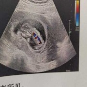 胎儿颈项透明（NT检查胎儿颈部透明层较厚约1.4mm正常吗）