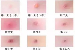 孕妇三个月了起水痘发烧39度多怎么办,孕期得水痘对胎儿有什么影响