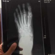 备孕期间可以拍ct吗（一直备孕中，脚意外受伤拍CT片子了，还能继续要孩子吗）