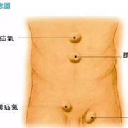 孕期腹股沟疝（儿童腹股沟疝气）