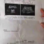 胎儿强光斑意味着什么（胎儿左心室有强光斑是什么意思啊？B超单是这样写的）