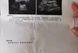胎儿强光斑意味着什么（胎儿左心室有强光斑是什么意思啊？B超单是这样写的）