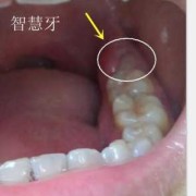 怀孕期间牙龈肿痛怎么办（怀孕12周了，牙疼的厉害，牙龈肿起来了，怎么办）