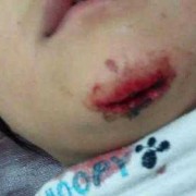宝宝下巴磕下去一块肉怎么处理,胎儿下巴尖是男是女