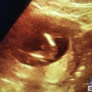 怀孕15周胎儿（怀孕15周羊水最大深度2.0cm正常吗）