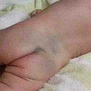 胎儿屁股朝外怎么办（胎儿屁股朝右）