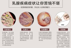 孕期乳腺增生（乳腺增生样改变是什么意思）