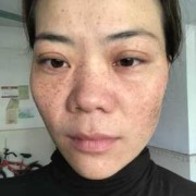 孕期雀斑（妊娠斑如何治疗）