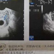怀孕八周孕囊多大正常,八周胎儿有多大图片