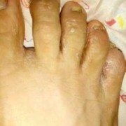 孕期脚趾痒（孕期脚趾痒）