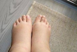 孕期腿浮肿（孕期腿浮肿是什么原因）