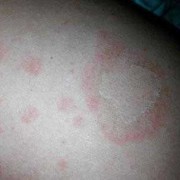 孕妇身上长了花斑癣怎么办,孕期花斑癣怎么治疗最好