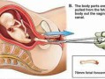 胎儿引产过程（引产步骤）