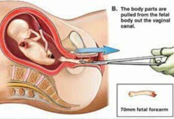 胎儿引产过程（引产步骤）