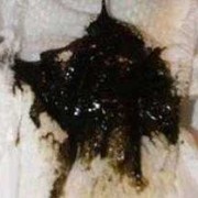 孕期拉屎黑色（孕妇上厕所大便黑色的正常嘛）