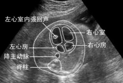 胎儿心脏强回声灶（胎儿心脏强回声灶是什么意思）