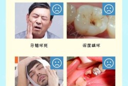 孕期牙齿坏了怎么办,孕期根管治疗危害