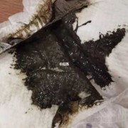 孕妇拉黑色大便怎么回事呢？怎么办好,孕期拉黑便便是怎么回事