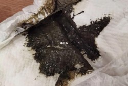 孕妇拉黑色大便怎么回事呢？怎么办好,孕期拉黑便便是怎么回事