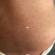 孕初期患湿疹怎么办，对胎儿有没有影响,孕妇湿疹会影响胎儿吗怎么办