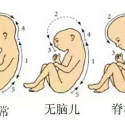 叶酸过多，会导致胎儿癫痫吗,胎儿羊癫疯的胎动特征