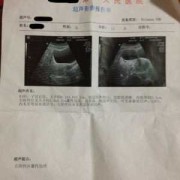 怀孕了右侧附件区囊肿怎么办,胎儿有囊肿是什么原因造成的