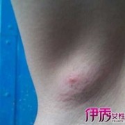 怀孕期间腋下淋巴结肿大（怀孕期间腋下淋巴结肿大怎么办）