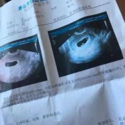 孕妇做彩超对胎儿有影响吗（怀孕彩超能检查出什么？一般怀孕多长时间可以做呢）